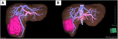 Case report: Minimal tissue damage and low coagulation liver resection for hepatoblastoma using indocyanine green fluorescence and water-jet dissector